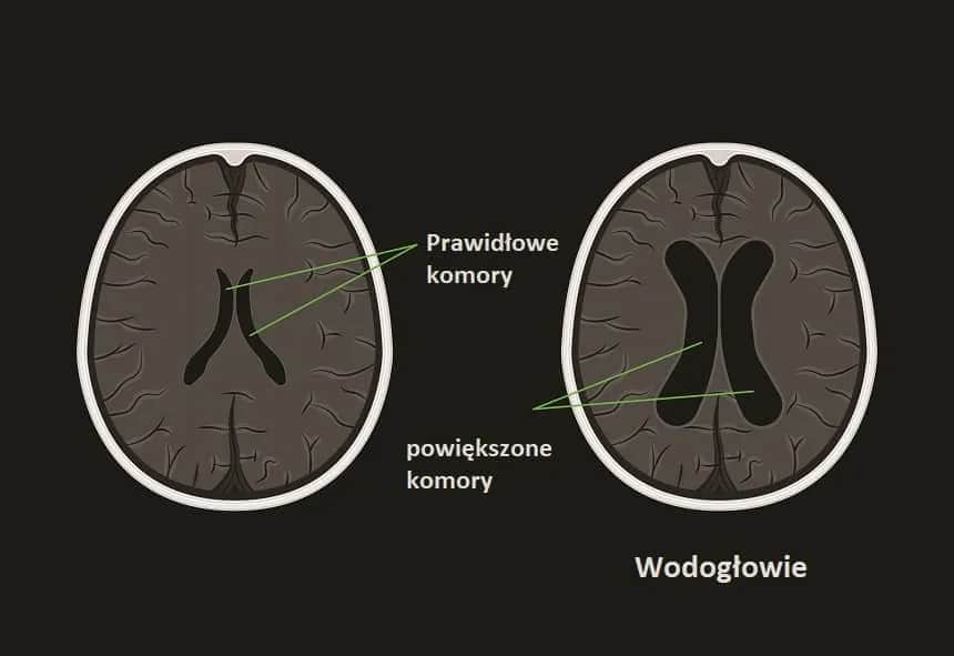 Wodogłowie u niemowląt: objawy, leczenie i co robić, gdy podejrzewasz?